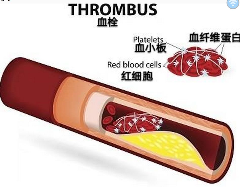名老中医治疗颈动脉粥样硬化案例,王清海治阳虚冠心病