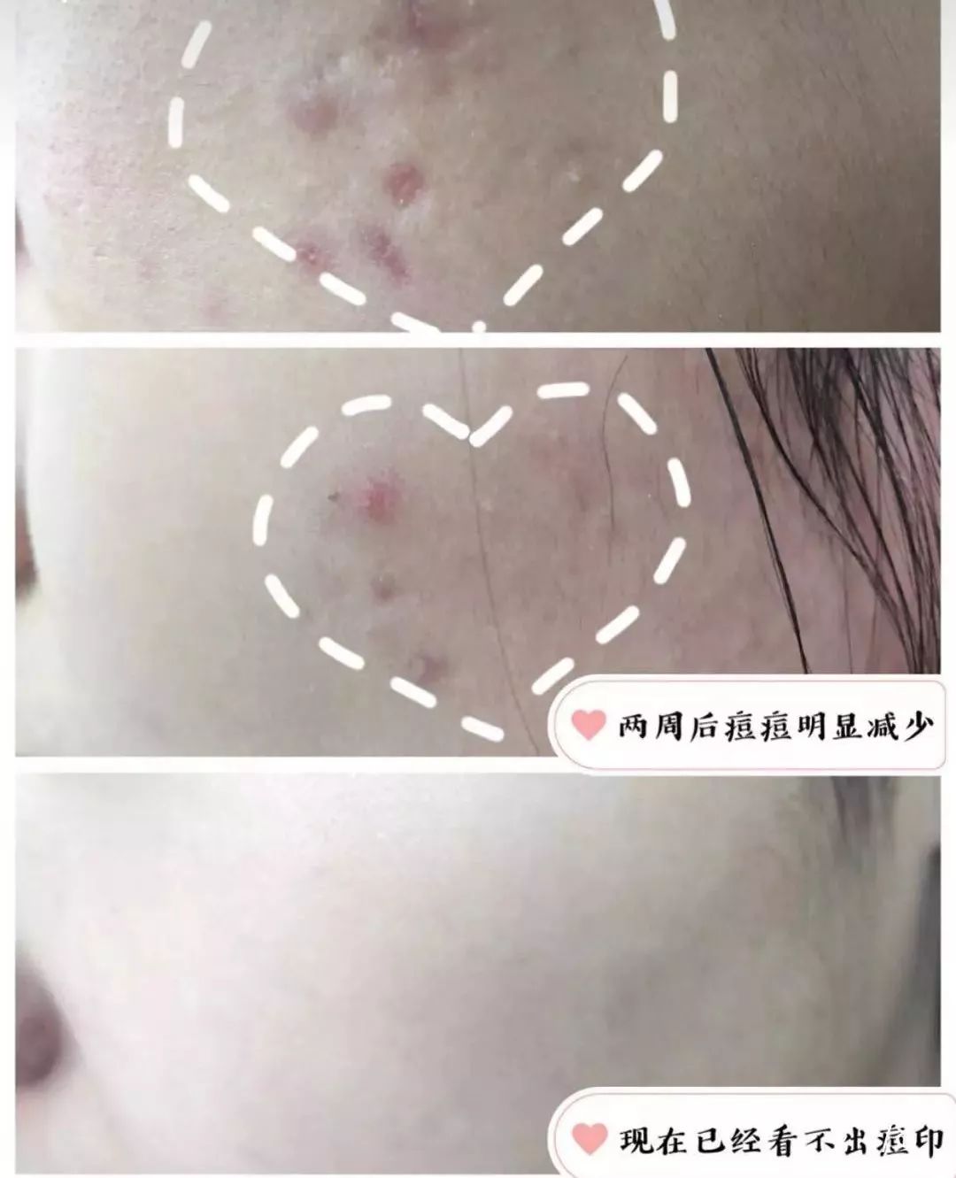 红肿,流脓的万年毒痘一喷全消失?岛国新晋痘肌终结者!彻底祛痘不反复!