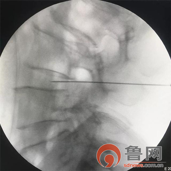 射频靶点热凝术治疗腰椎间盘突出,硬膜外腔注射治疗腰椎间盘突出症