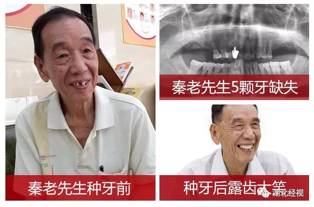 全城征集免费种植牙,全城征集免费种牙