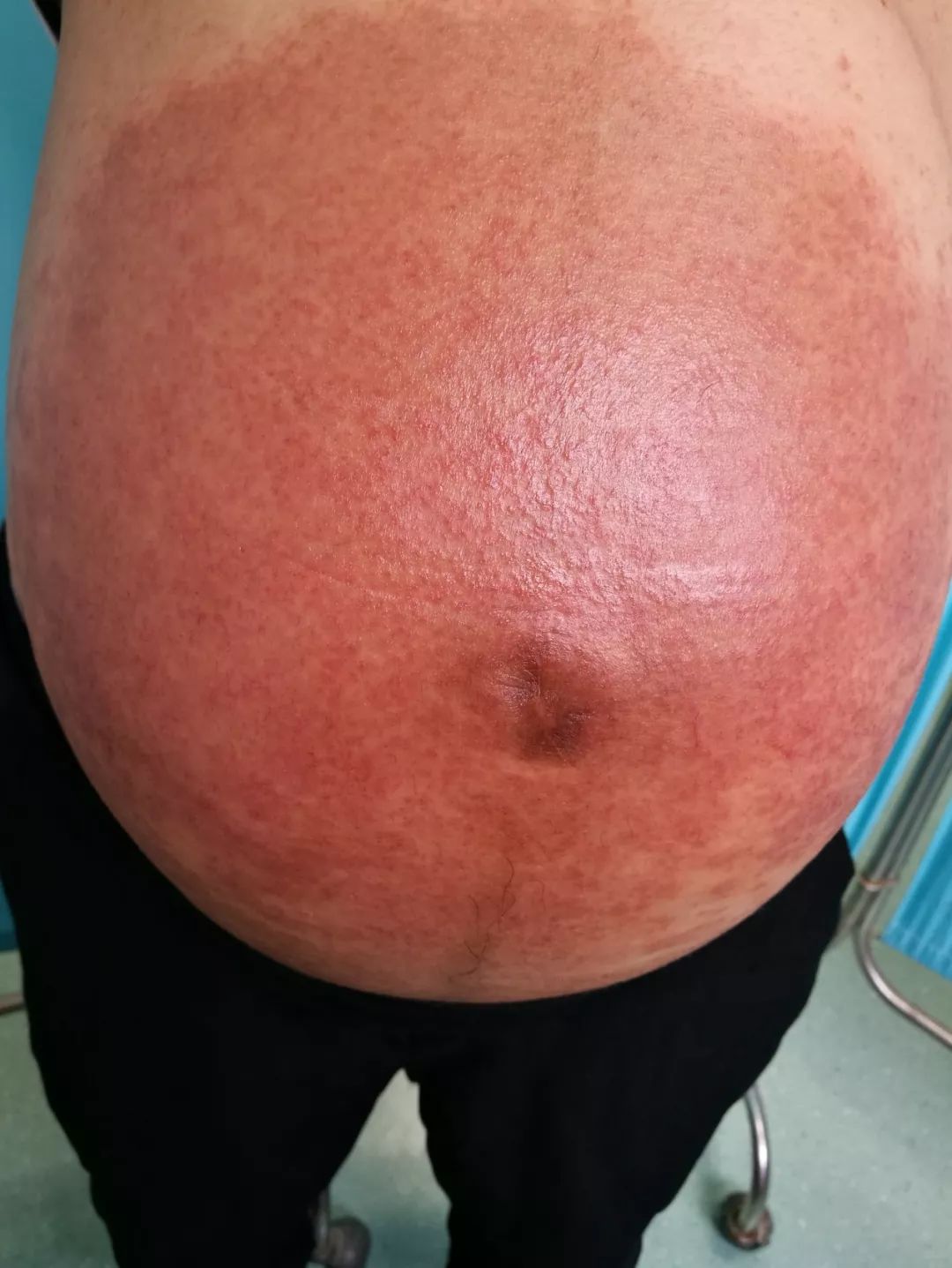 孕妇湿疹不可怕，中医治疗有奇效