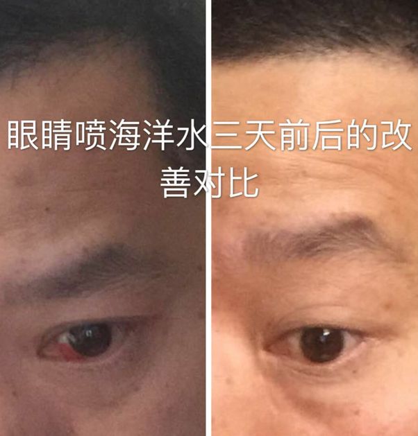 每天喷2下，近视竟然降低了200度？西班牙人都买疯了！还能缓解眼部疲劳，预防老花眼、白内障！