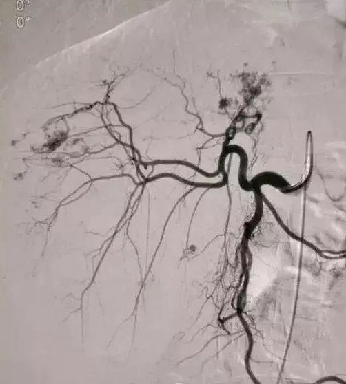 微创介入治疗肿瘤是什么科,介入治疗肿瘤副作用