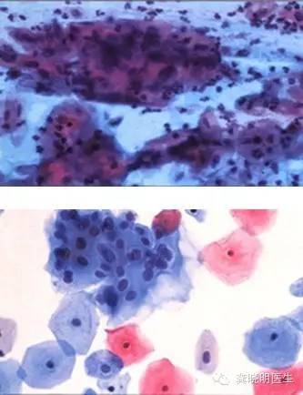 如何看懂宫颈刮片检验单,宫颈刮片报告怎么看