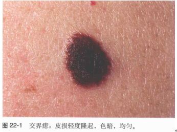 你说不“痣”道的事！