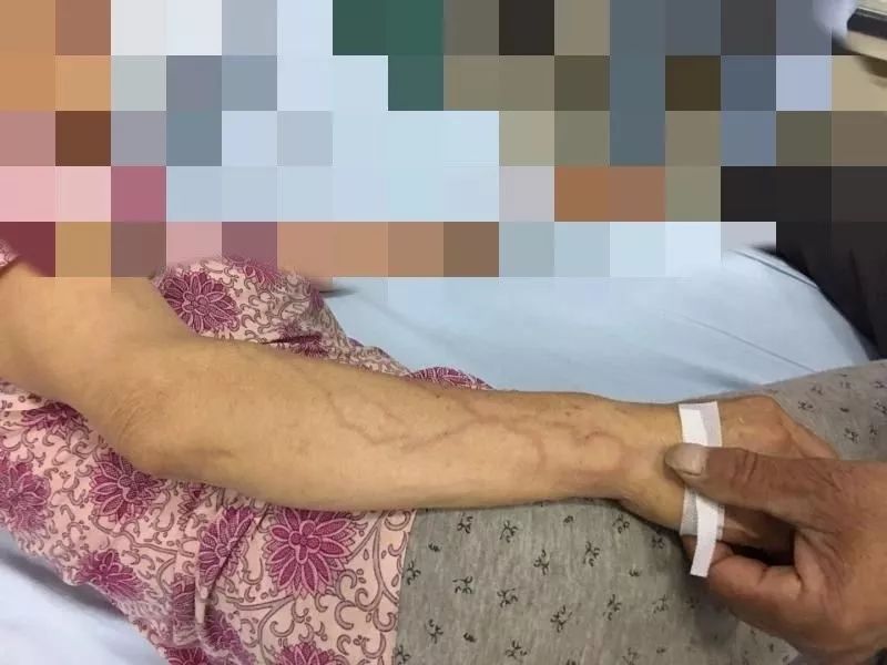 输液后腿上起红点怎么回事,输液之后手臂上出现红点