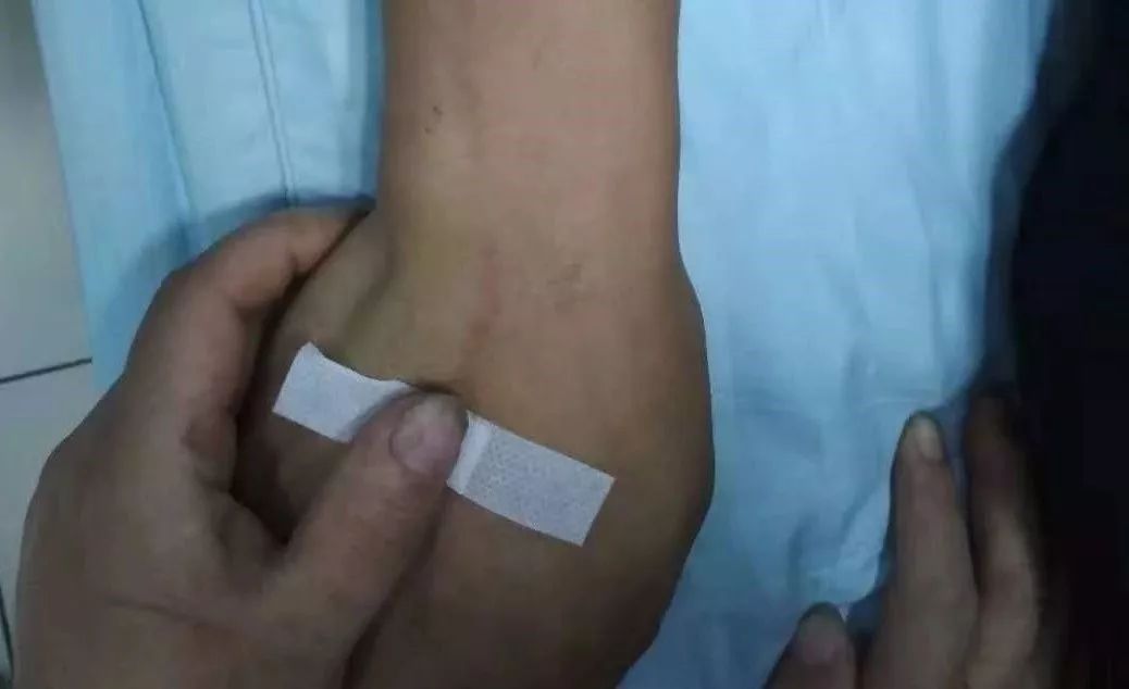 输液后腿上起红点怎么回事,输液之后手臂上出现红点