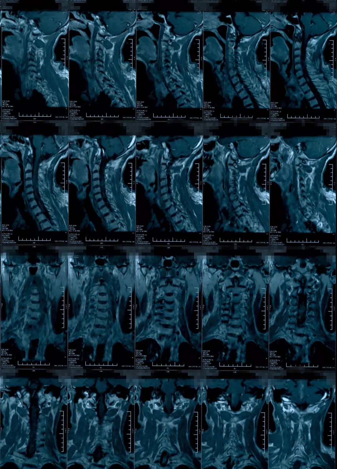 椎管狭窄水肿最佳治疗方法,椎管水肿如何治疗