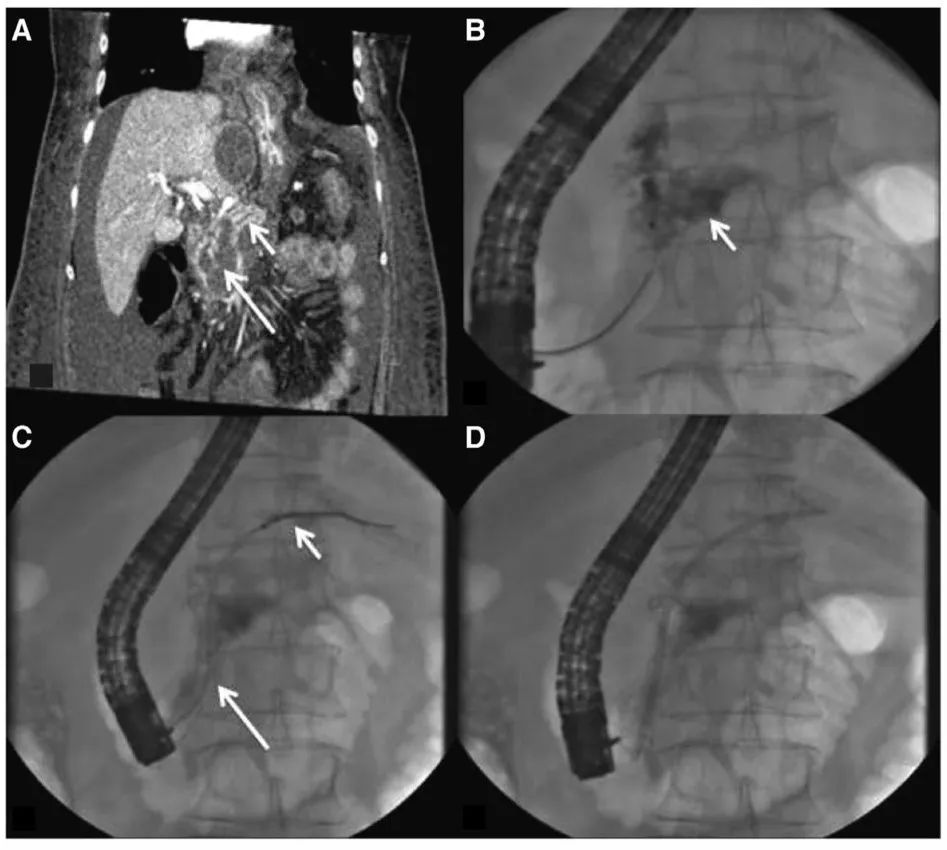 权威研究说，胰腺液体积聚引流，内镜可以这样用