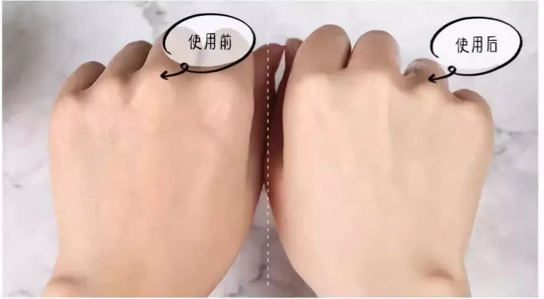 脱发算啥!90后已经开始长“老年斑”了,有人还为此花了10多万!