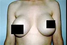 隆胸风险大还是缩胸大,胸大重要还是瘦重要