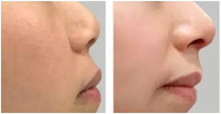 激光美容技术有用吗,解读激光美容的六大疑惑