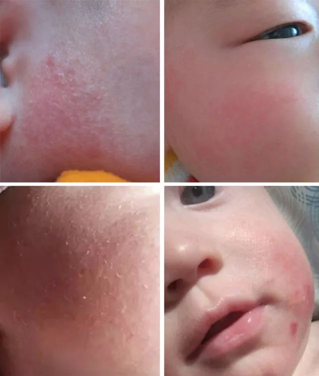 宝宝肌肤换季敏感如何预防,换季宝宝皮肤护理