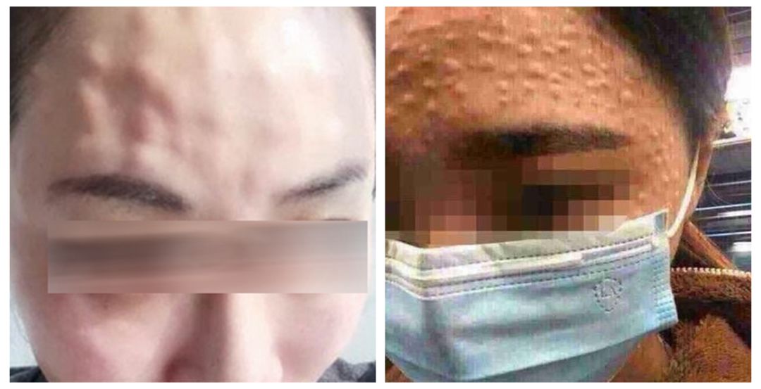 水光针副作用这么可怕,水光针有什么医疗隐患吗