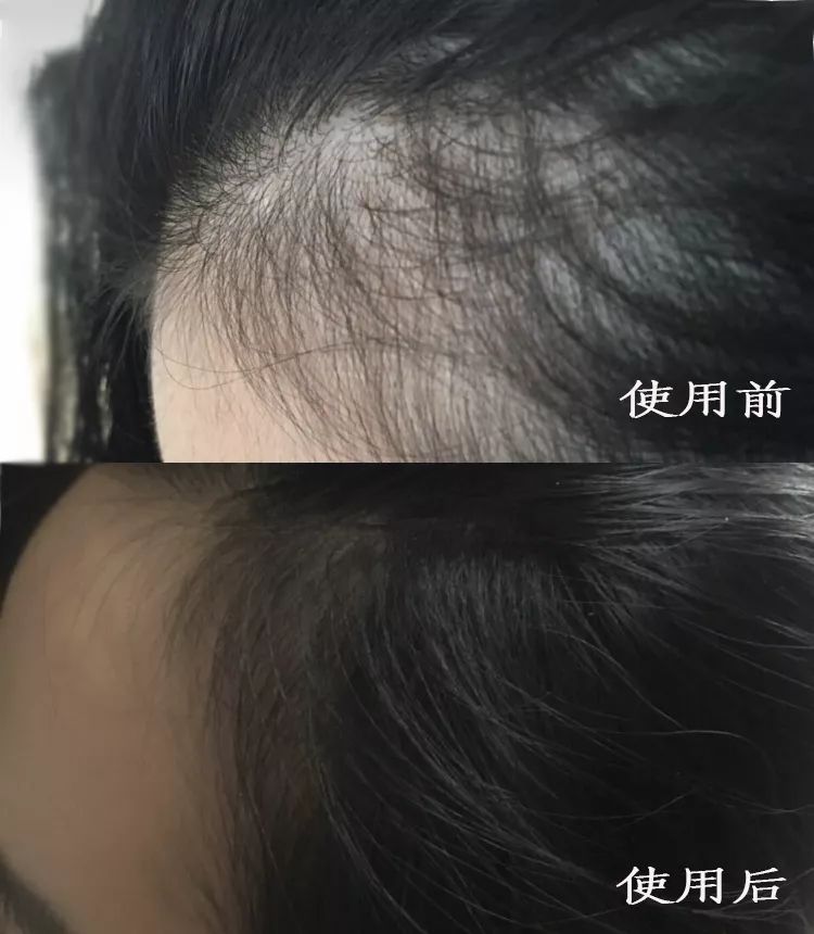 疯狂掉头发发际线后移,疯狂掉头发头发变得稀疏
