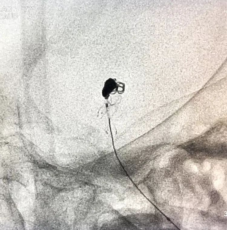 柳暗花明专栏|栓塞颅内动脉瘤时微导管无法穿过LVIS支架网眼怎么办