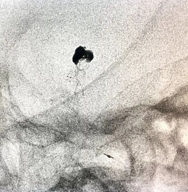 柳暗花明专栏|栓塞颅内动脉瘤时微导管无法穿过LVIS支架网眼怎么办