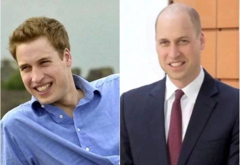 头秃拯救方式,头秃怎么拯救额头