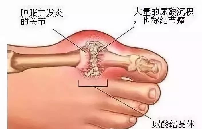 康复锻炼手麻是怎么回事,手麻的治疗思路这5个点要记住
