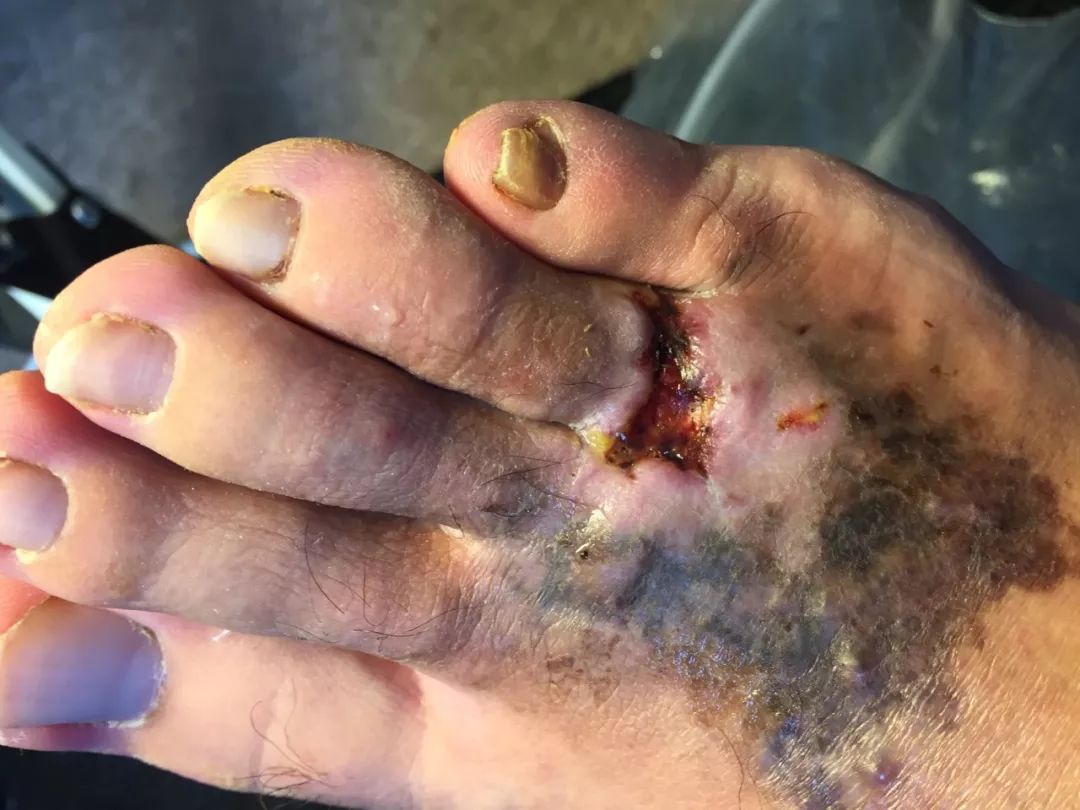 俄罗斯留学生骨折截肢,留学生意外被截肢