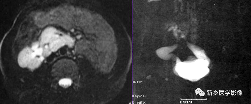 肾脏形态变异怎么办,肾脏疾病鉴别五项意义