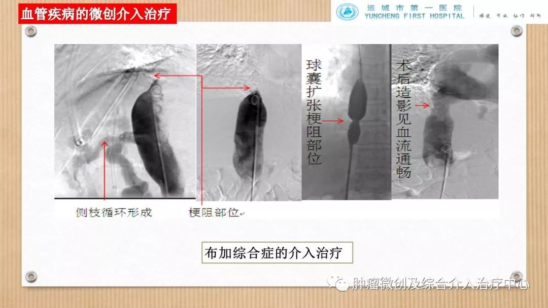 脾动脉栓塞术,脾栓塞手术的适应症