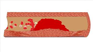 血管堵演示,血管堵塞100张图片