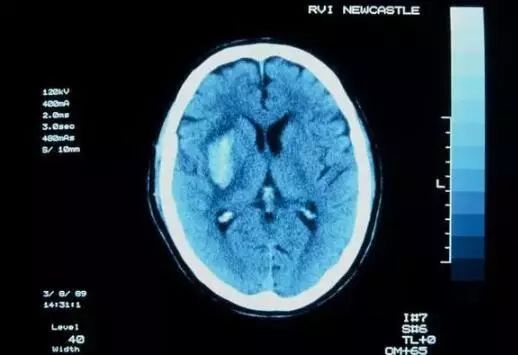 阿司匹林肠溶片能不能长期吃,阿司匹林肠溶片一定要长期吃吗