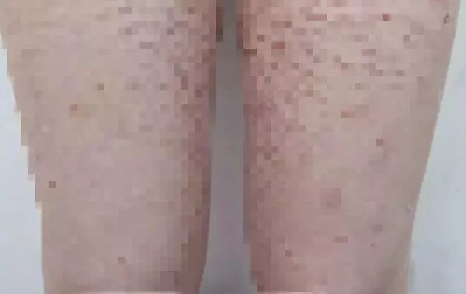 后悔！5岁女儿浑身长黑毛，遍布红斑，就因妈妈用了这种药！