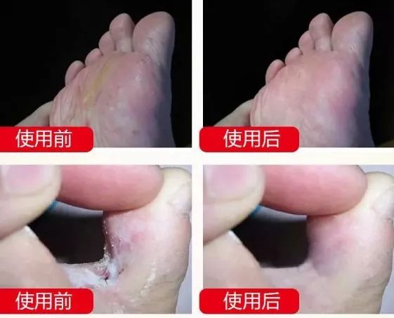 脚臭怎么办教你一招永远除臭,脚臭有什么办法除臭小妙招