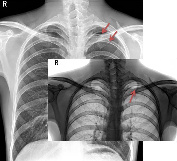 气胸的x线表现胸膜炎,胸外科气胸病人病例