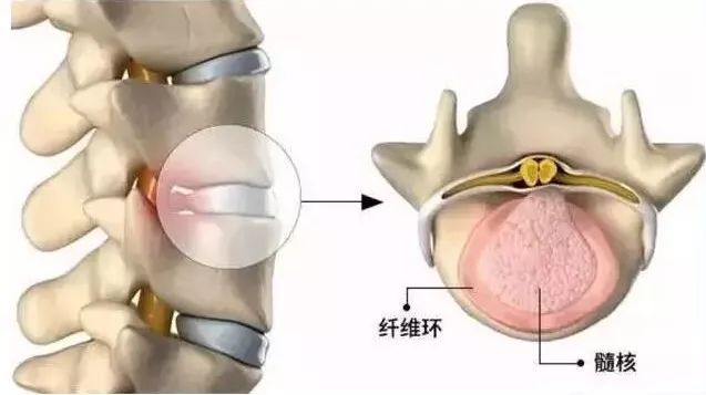 腰椎间盘突出压迫神经腿疼脚掌麻,腰椎间盘突出的真相您了解吗