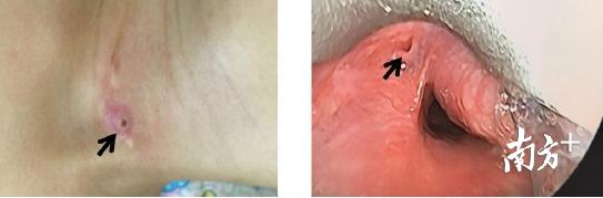 脖子挖个洞能治愈吗,脖子开刀有个洞怎么愈合