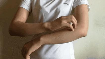 湿疹晒伤后抹什么药膏,日晒皮炎湿疹用什么止痒