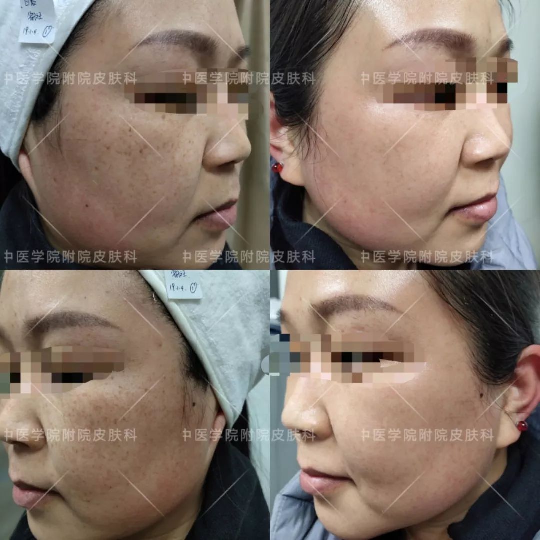 光子嫩肤优惠活动,医院光子嫩肤打特价