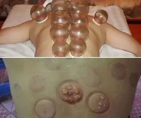 湿气重生百病老中医推荐祛湿方,国医大师治湿气最好的方子