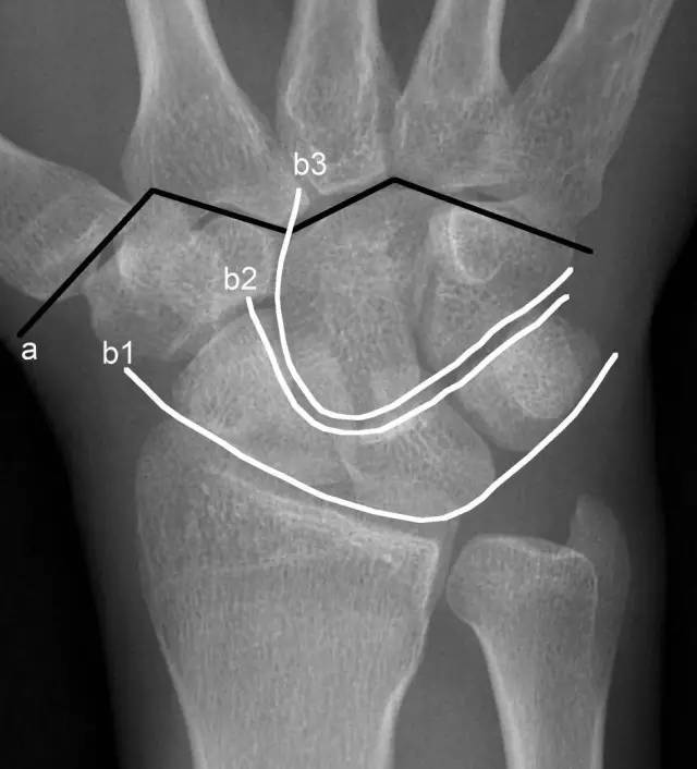 青少年尺腕关节脱位x线诊断标准,腕关节侧位x线片读片技巧