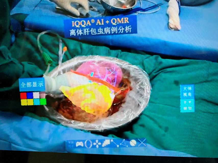 肝包虫手术切除简报,切除肝肿瘤第一视角