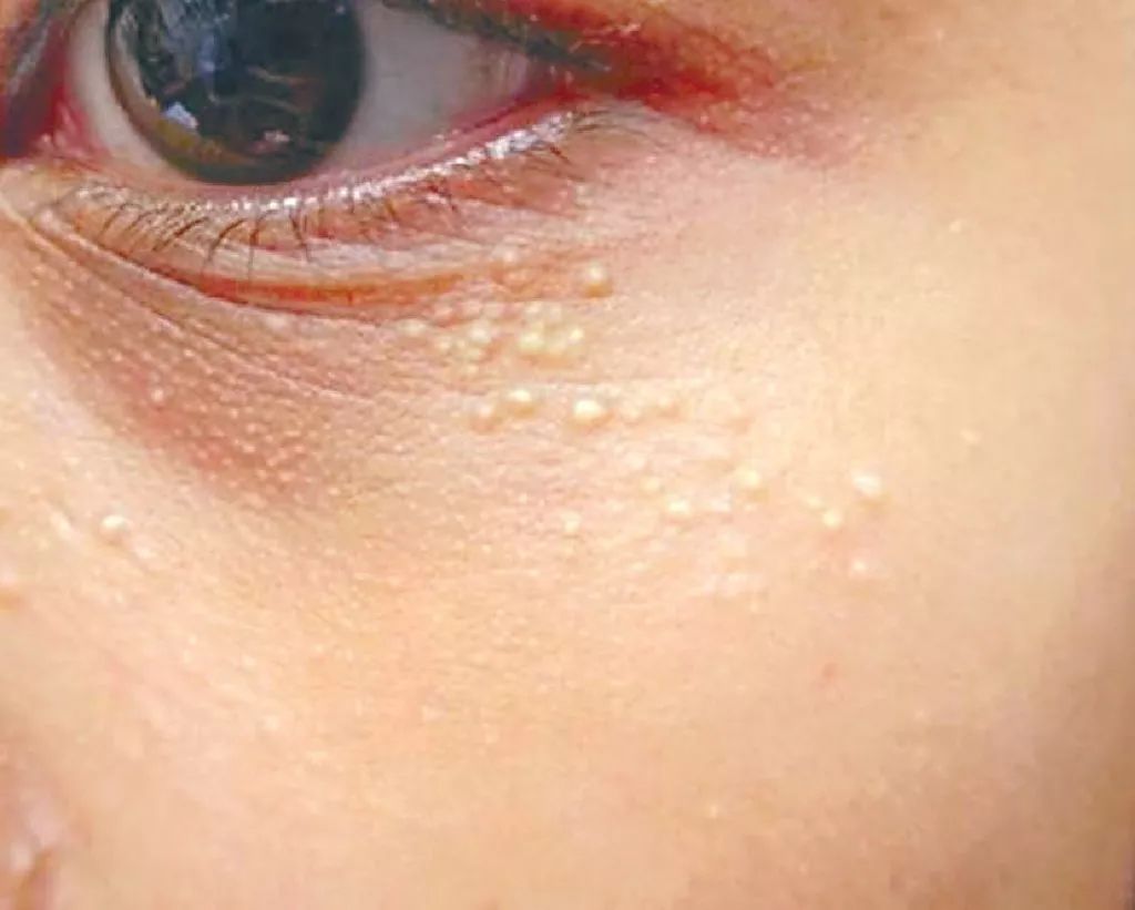 涂眼霜会不会长肉粒,涂眼霜会不会导致眼袋越来越严重