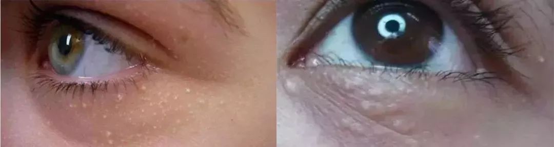 涂眼霜会导致脂肪粒？No