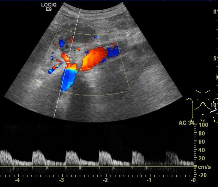 超声技术在肾性高血压中的应用