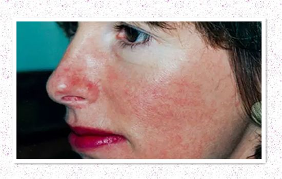 痘印红血丝修复护肤品平价,痘印泛红团购