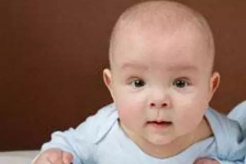 宝宝得了湿疹皮炎怎么办,婴儿特殊类型的湿疹以及皮炎