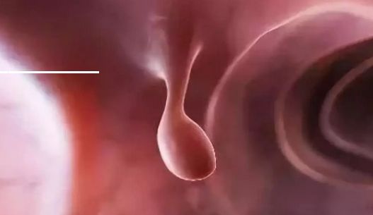 肠息肉和胆囊息肉必须做手术吗,有肠息肉胃息肉胆囊息肉怎么办