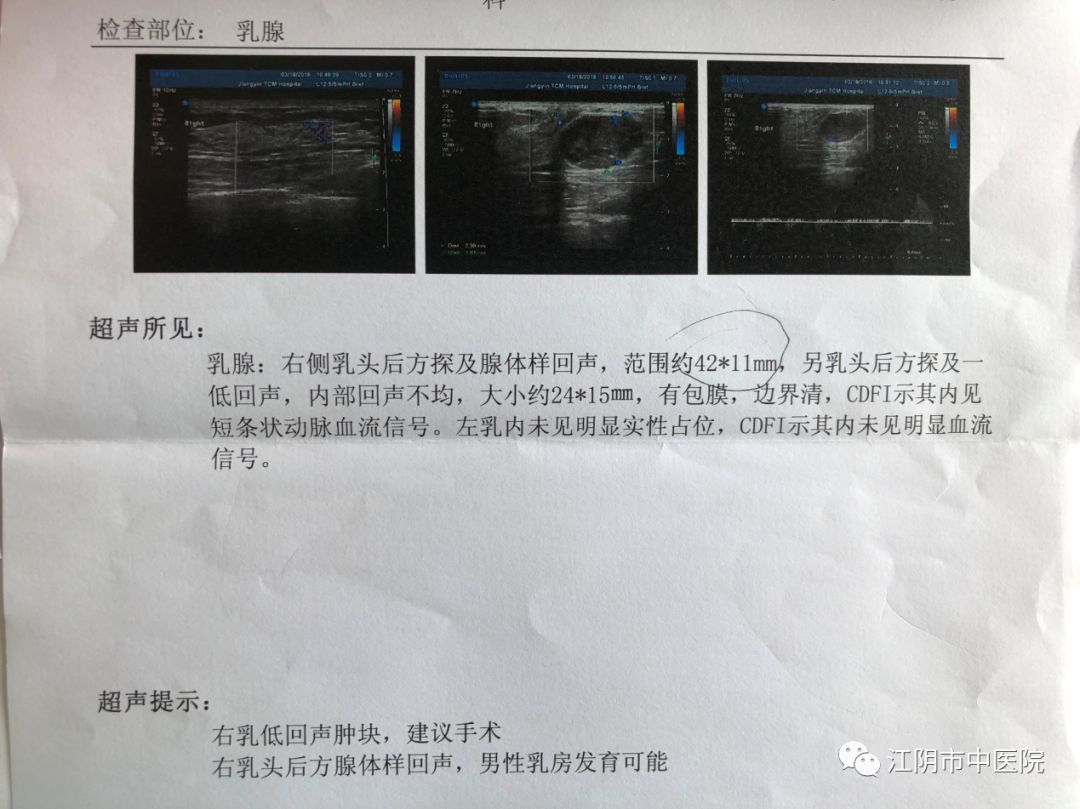 江苏71岁老汉进整形科看病，一查竟是乳腺癌！