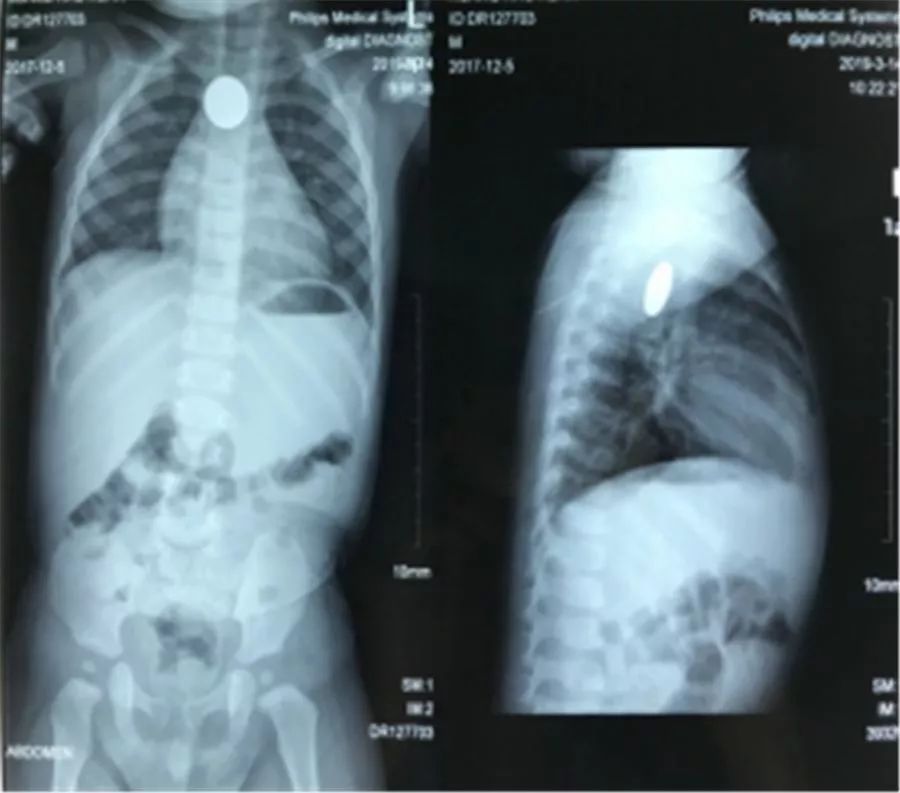 1岁娃连吐四五天，最后竟要全麻手术！只因爸爸忽视了一句话……