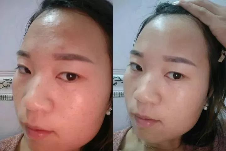 拨黑头工具草莓鼻,去黑头神器真的能吸出黑头