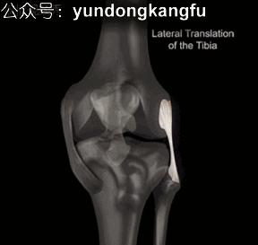 膝腓侧副韧带损伤怎么恢复,膝内侧副韧带损伤修复视频