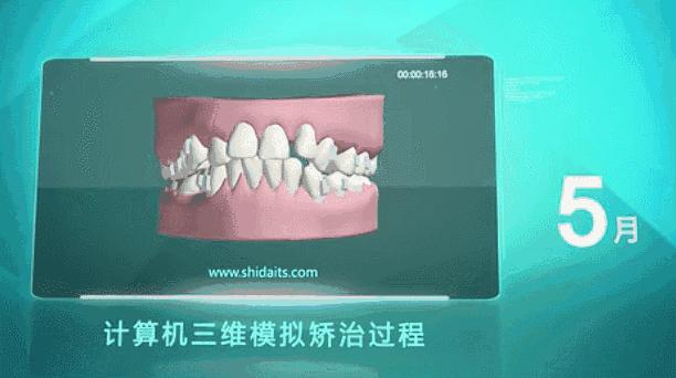 昆明龅牙矫正要多少钱,长沙轻微龅牙矫正要多少钱