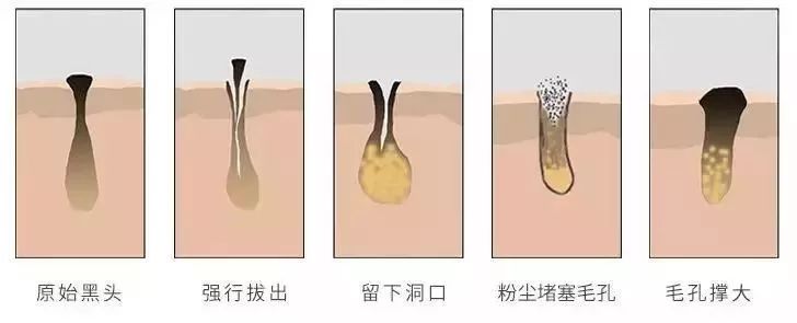 又爽又恶心的去黑头方法来了！5分钟将你10年的黑头白头连根拔起！